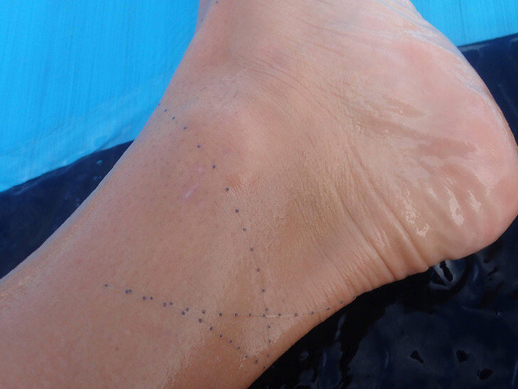 A Stinging Tentacle Got Wrapped Around An Ankle